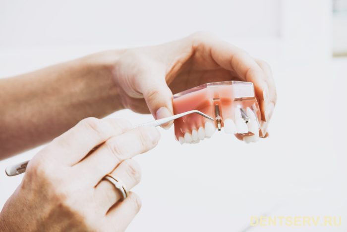 имплантация зубов в москве
