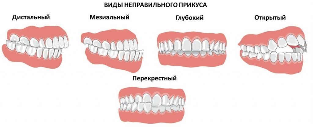 исправление прикуса зубов